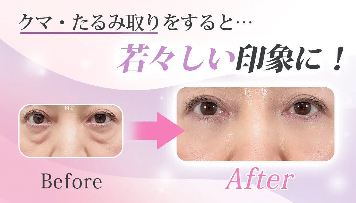 クマ・たるみ取りをすると…若々しい印象に！