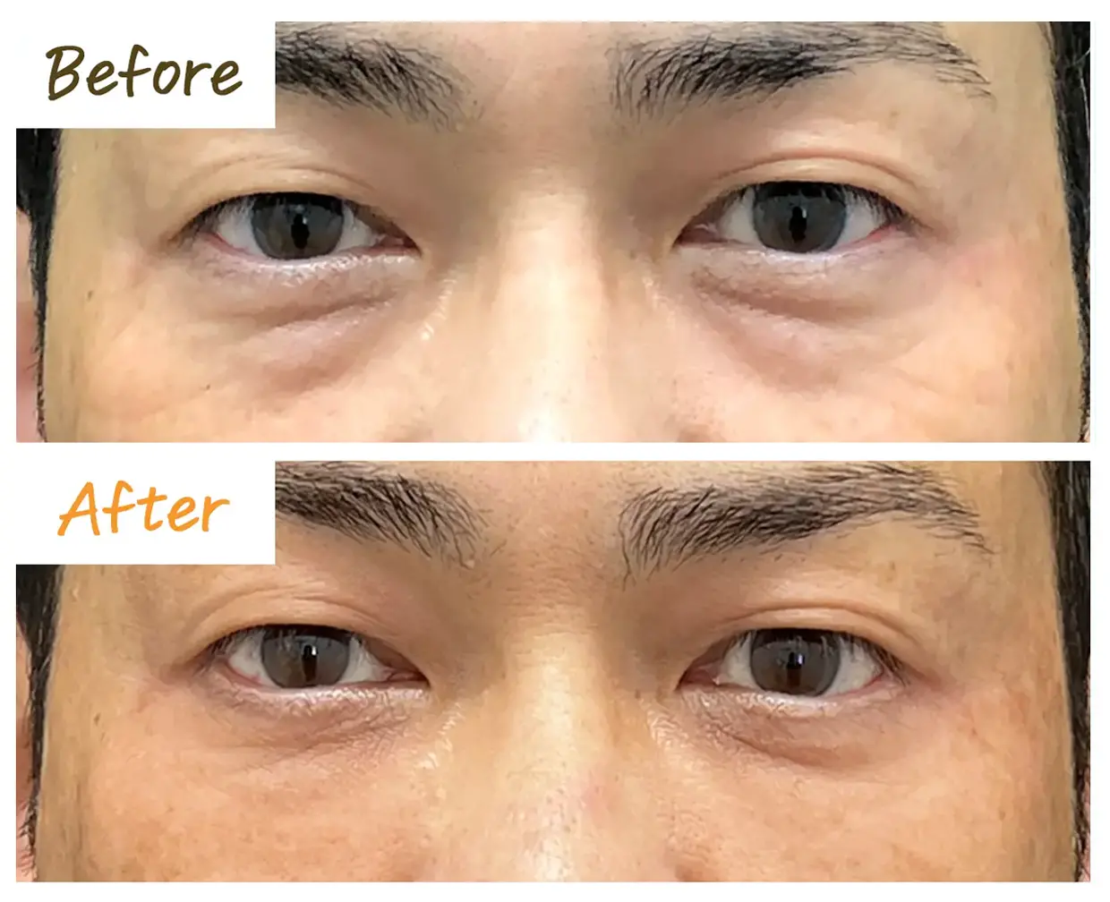 切らない施術のbeforAfter画像