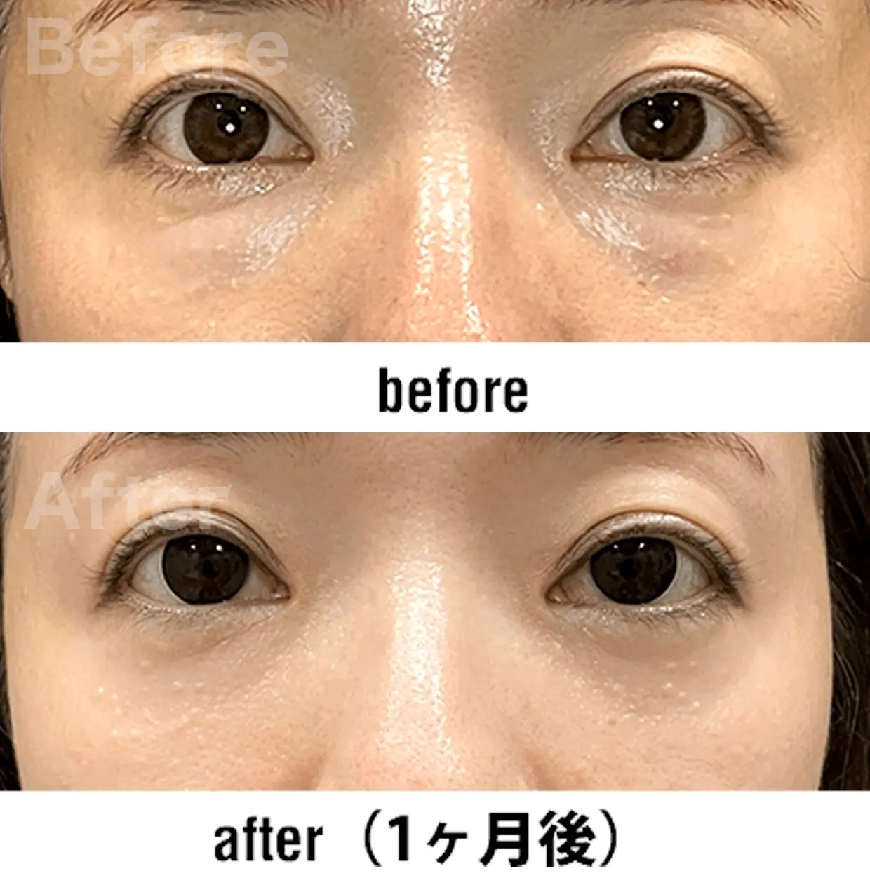 切らない施術のbeforAfter画像