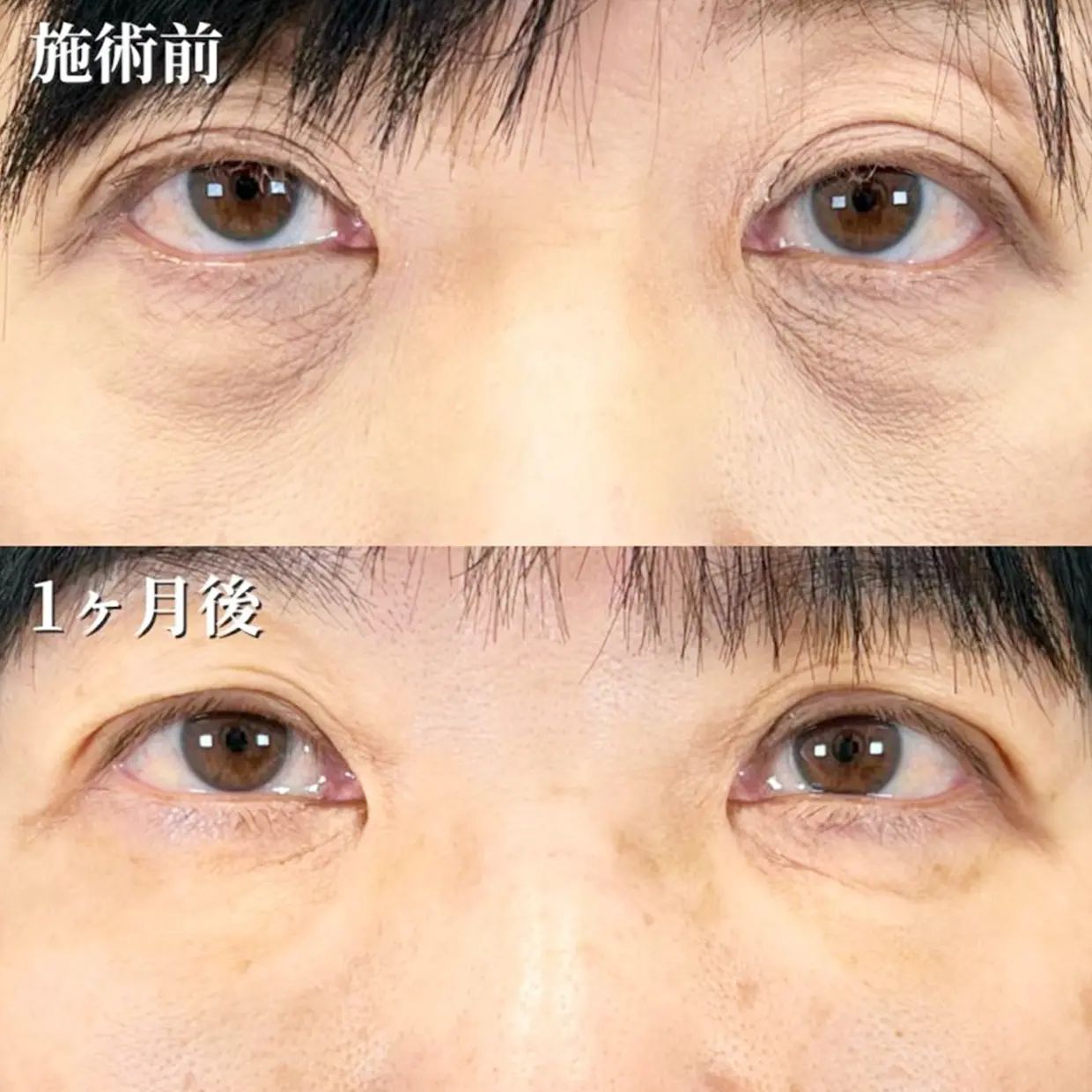 切らない施術のbeforAfter画像